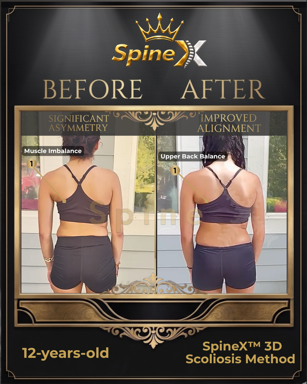 Lucia’s rear-view before-and-after posture comparison from personalized SpineX coaching