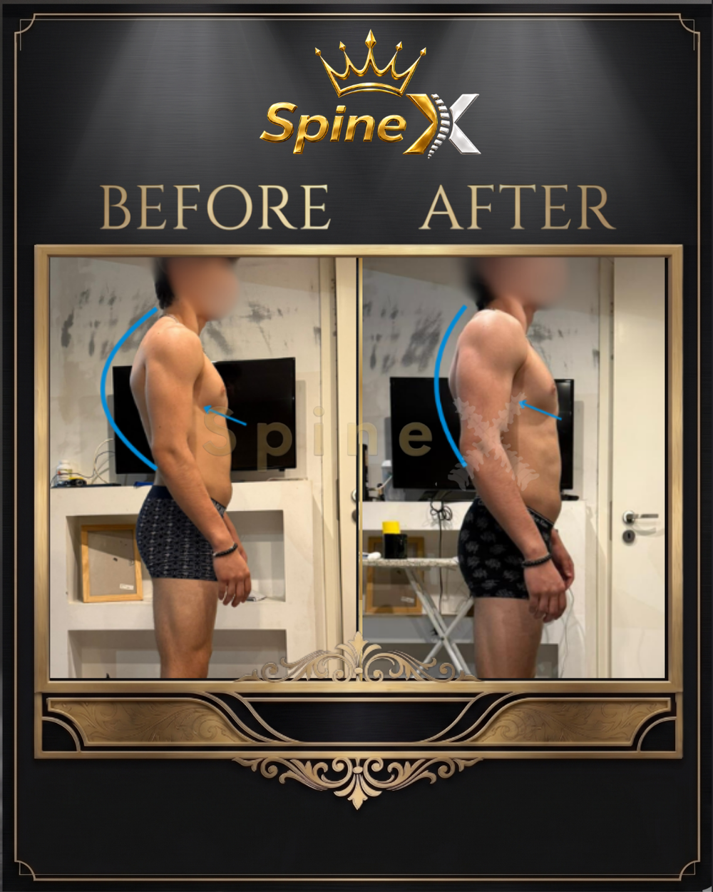 Before-and-after posture photos of an individual SpineX coaching client