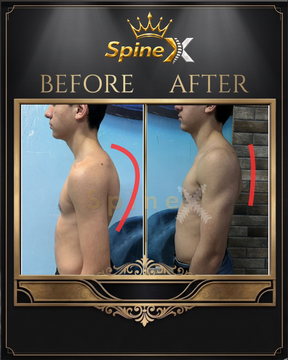 Before-and-after posture photos of an individual SpineX coaching client
