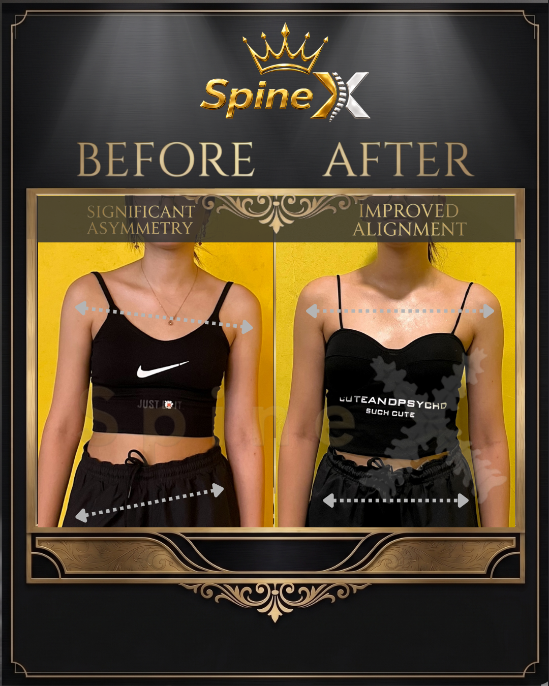 Before-and-after posture comparison supplied for individual SpineX scoliosis coaching, example 1. Individual results vary.