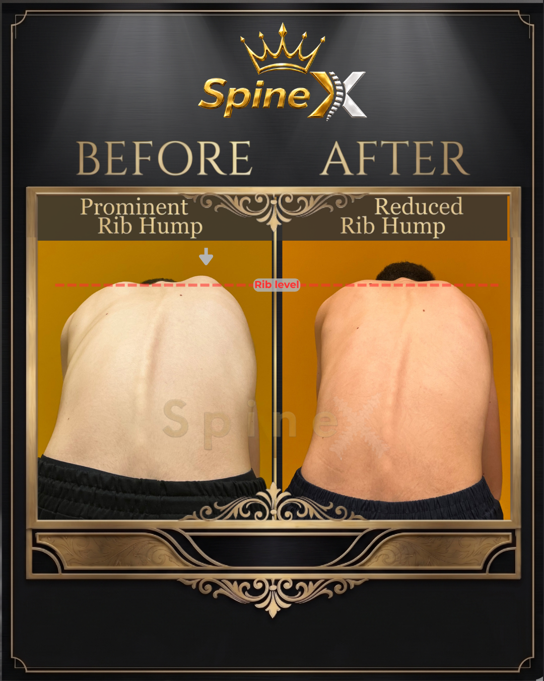 Before-and-after posture comparison supplied for individual SpineX scoliosis coaching, example 4. Individual results vary.
