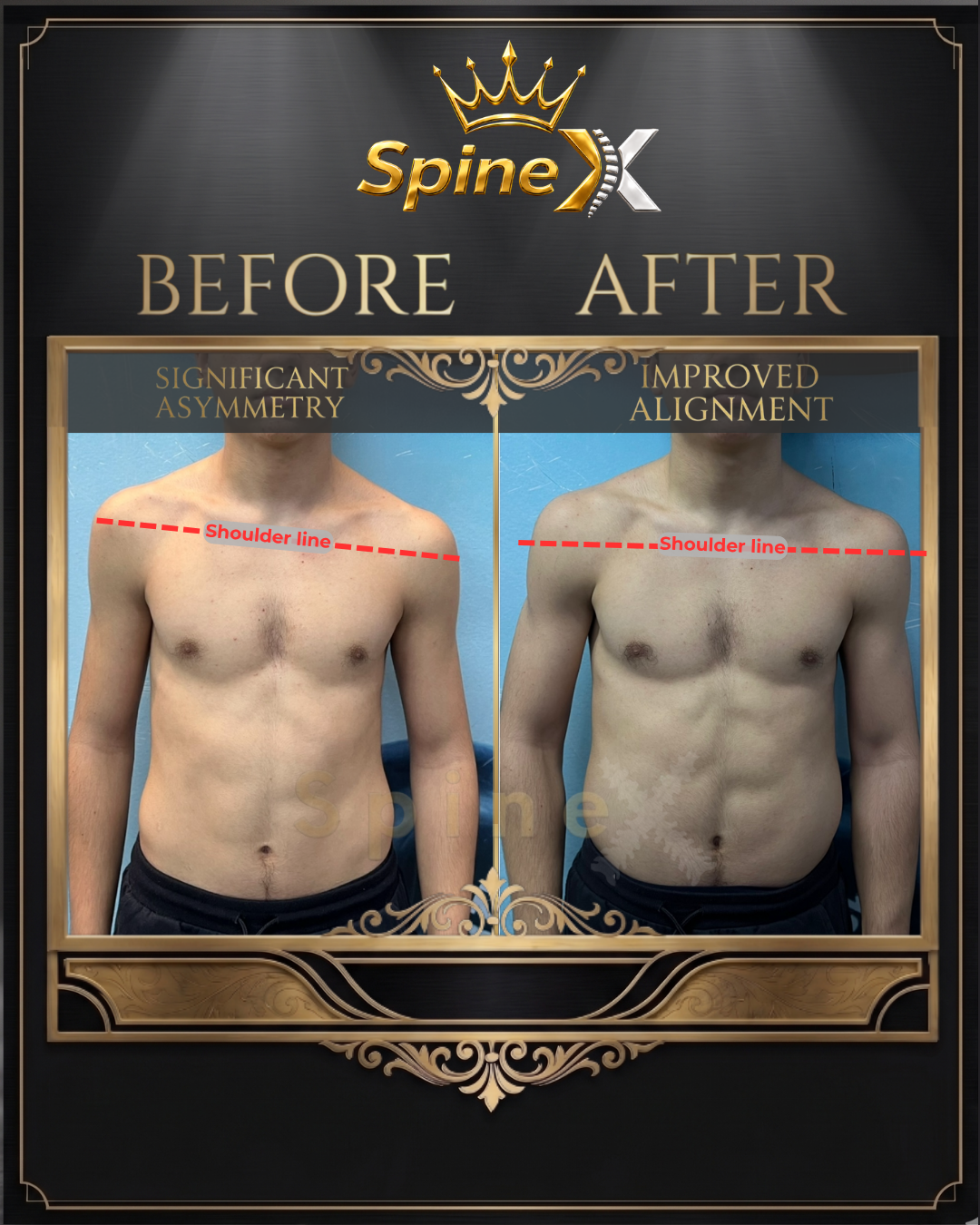 Before-and-after posture comparison supplied for individual SpineX scoliosis coaching, example 6. Individual results vary.