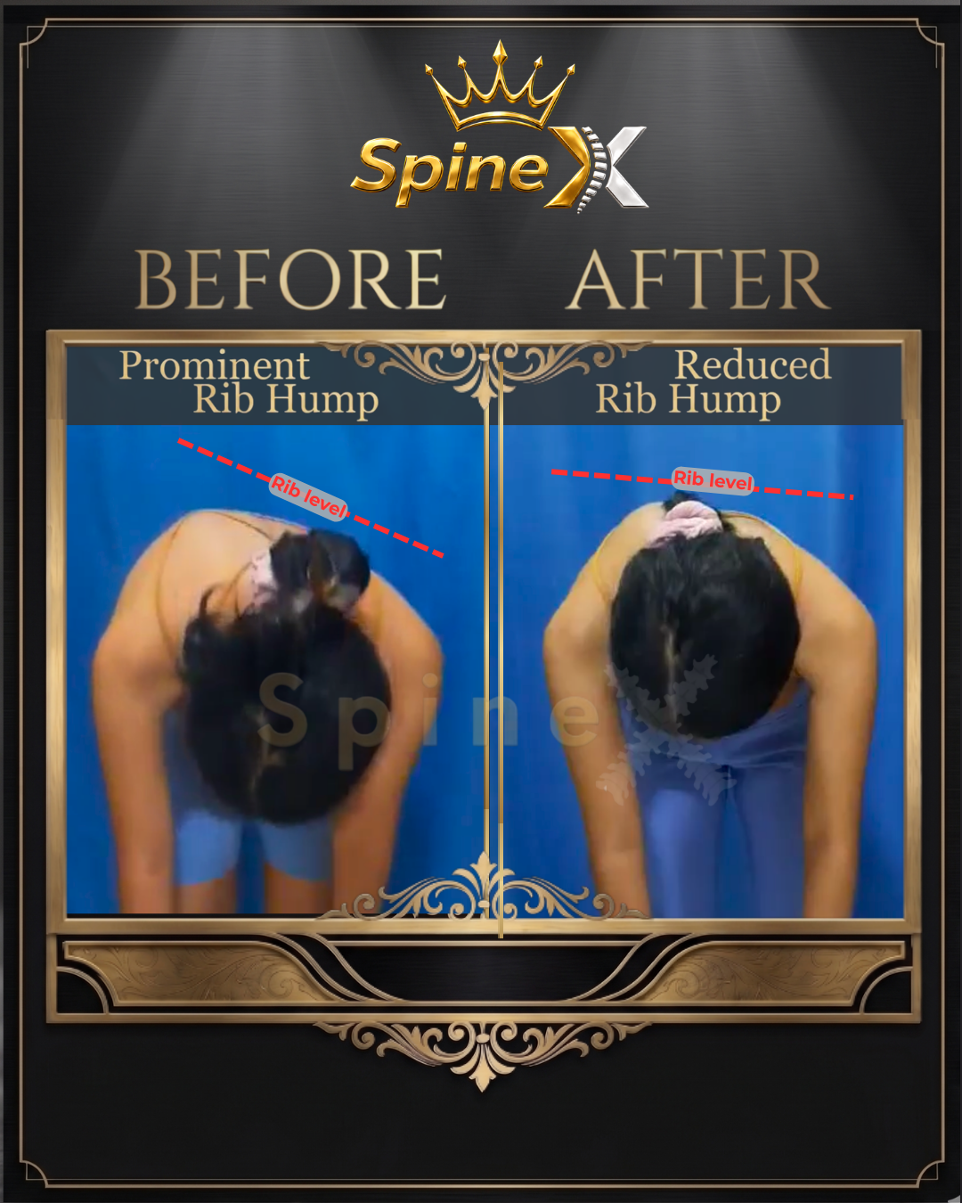 Before-and-after posture comparison supplied for individual SpineX scoliosis coaching, example 7. Individual results vary.