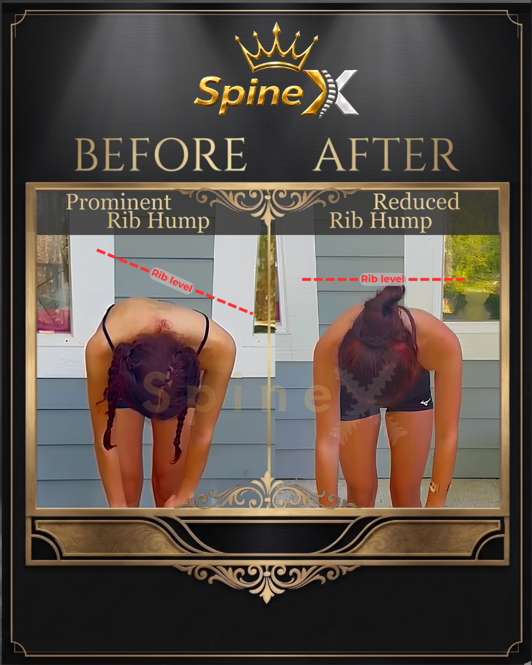 Before-and-after posture comparison supplied for individual SpineX scoliosis coaching, example 8. Individual results vary.