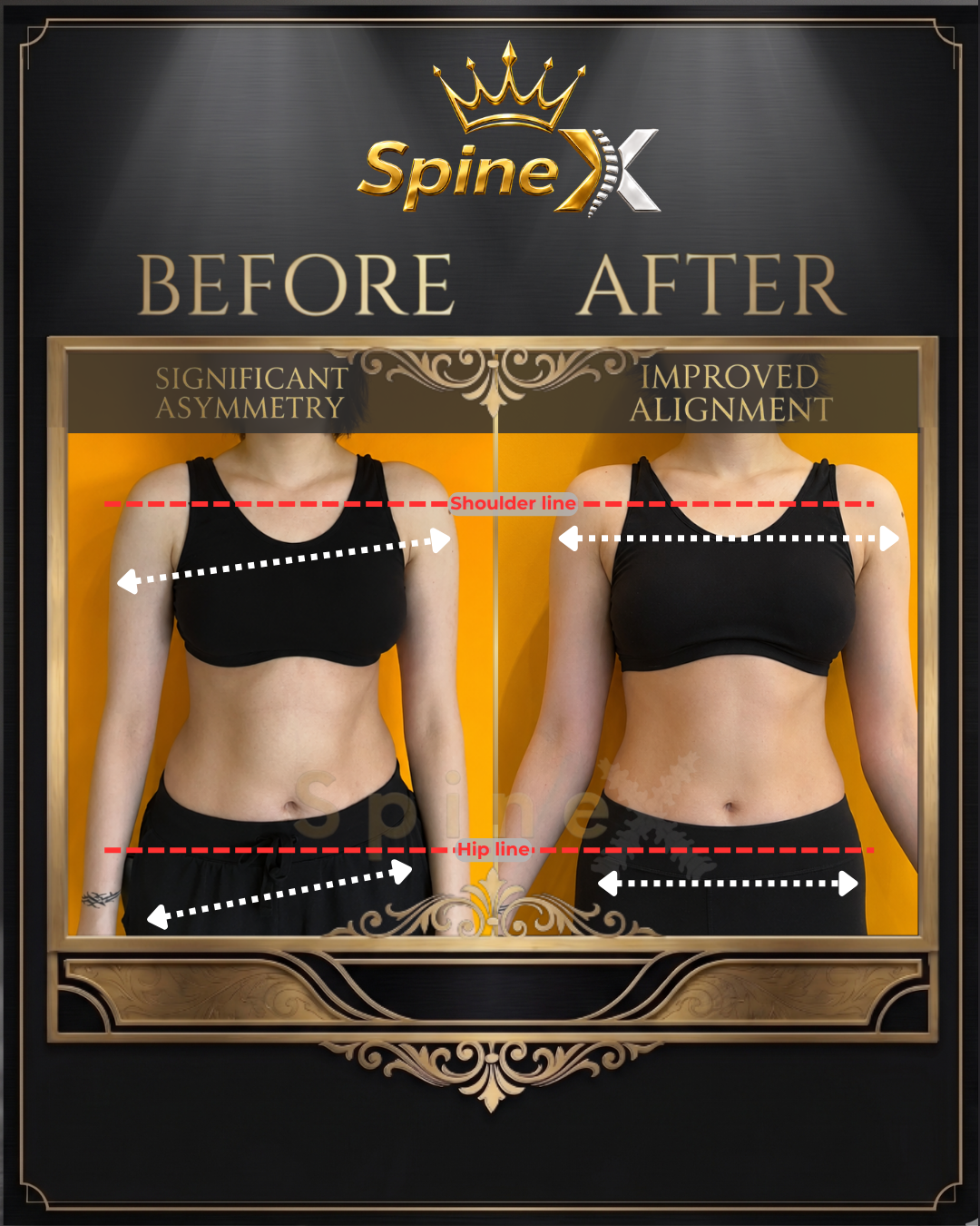 Before-and-after posture comparison supplied for individual SpineX scoliosis coaching, example 12. Individual results vary.