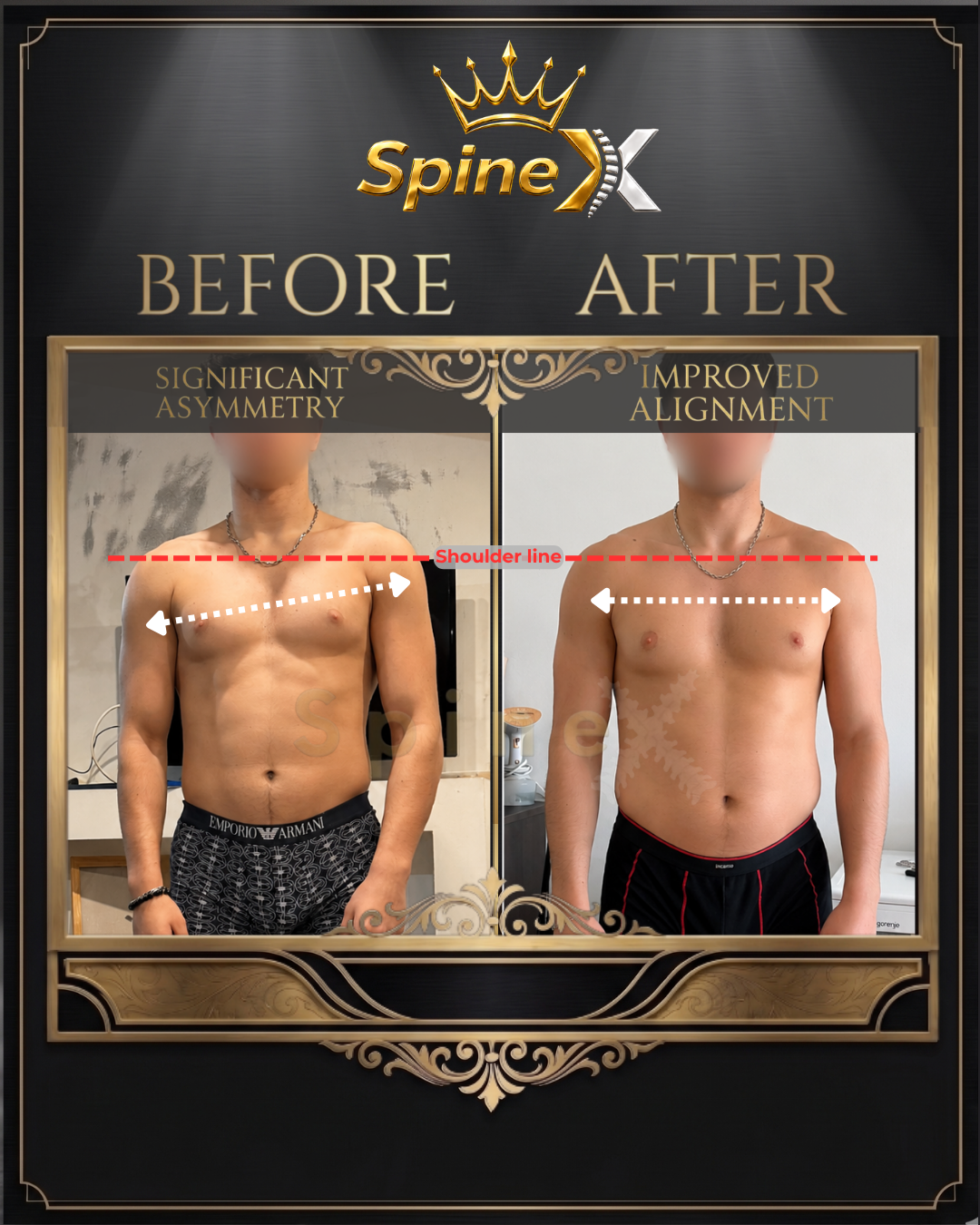 Before-and-after posture comparison supplied for individual SpineX scoliosis coaching, example 14. Individual results vary.