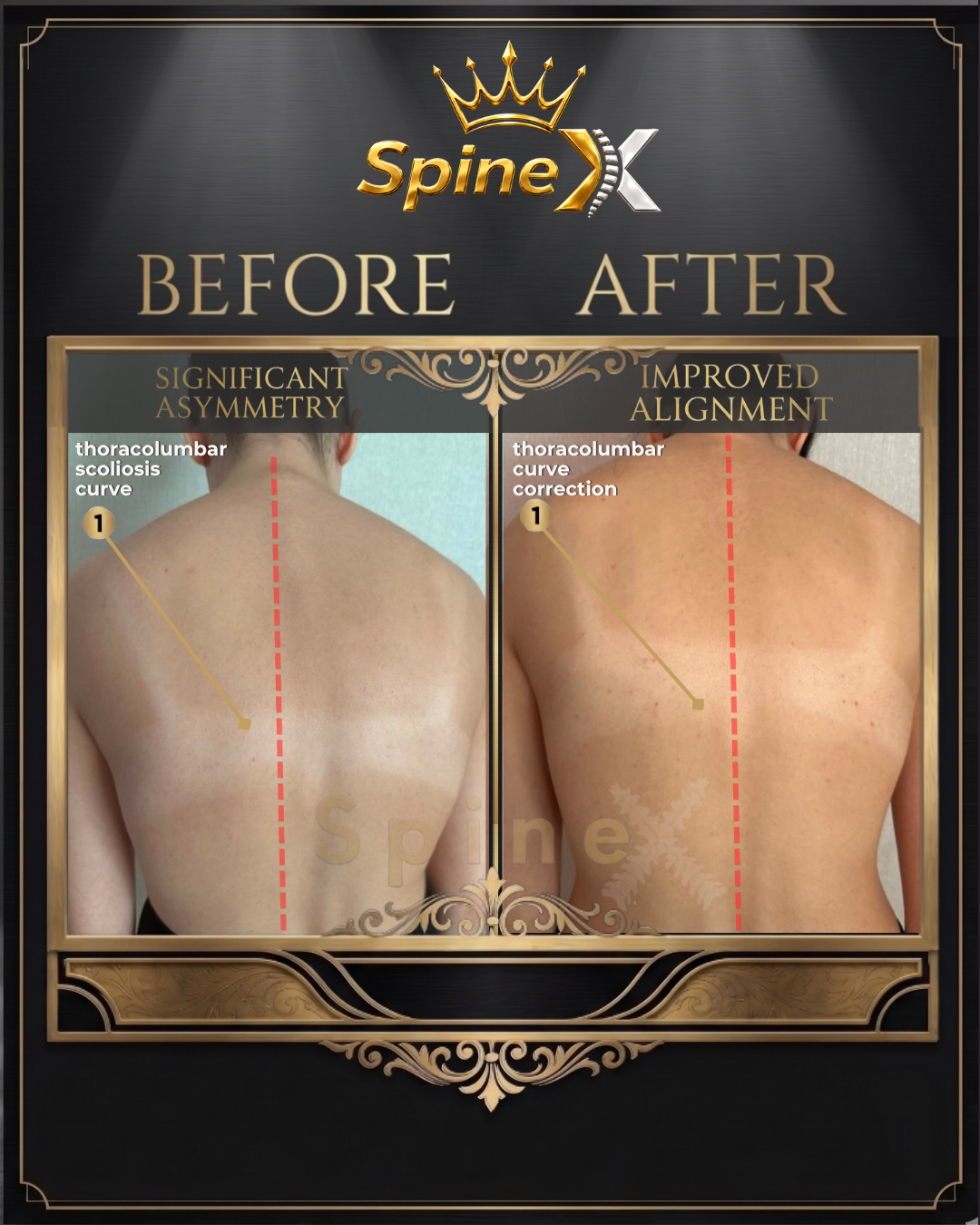 Before-and-after posture comparison supplied for individual SpineX scoliosis coaching, example 16. Individual results vary.