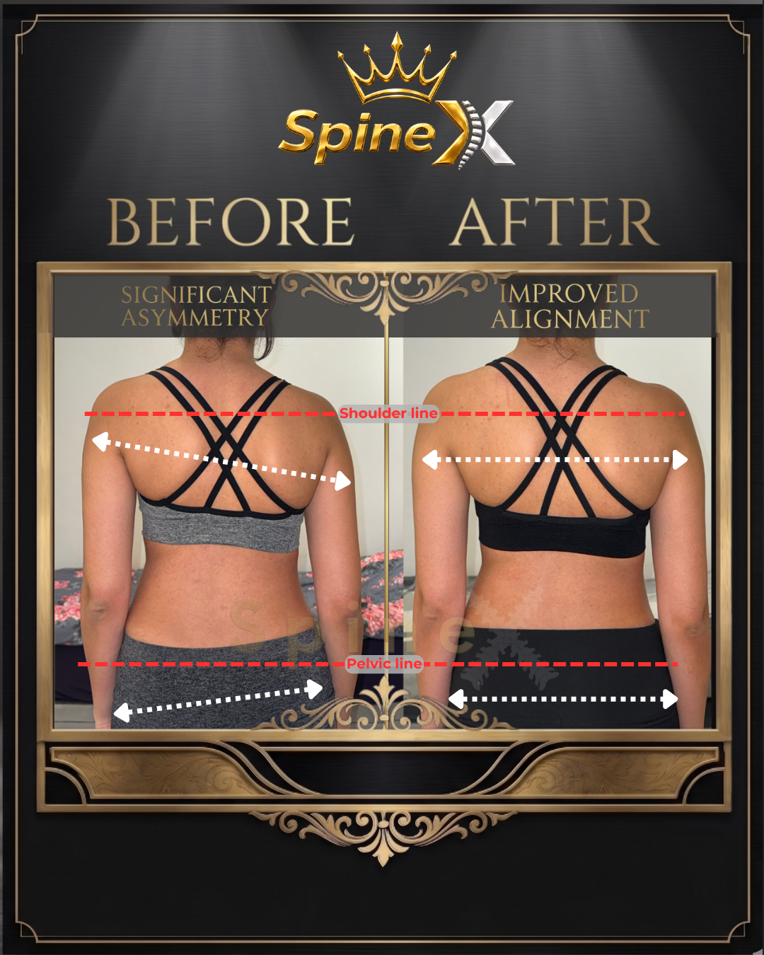 Before-and-after posture comparison supplied for individual SpineX scoliosis coaching, example 18. Individual results vary.