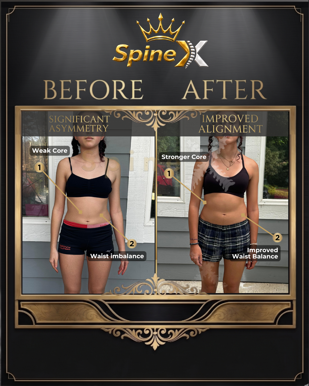 Before-and-after posture comparison supplied for individual SpineX scoliosis coaching, example 32. Individual results vary.