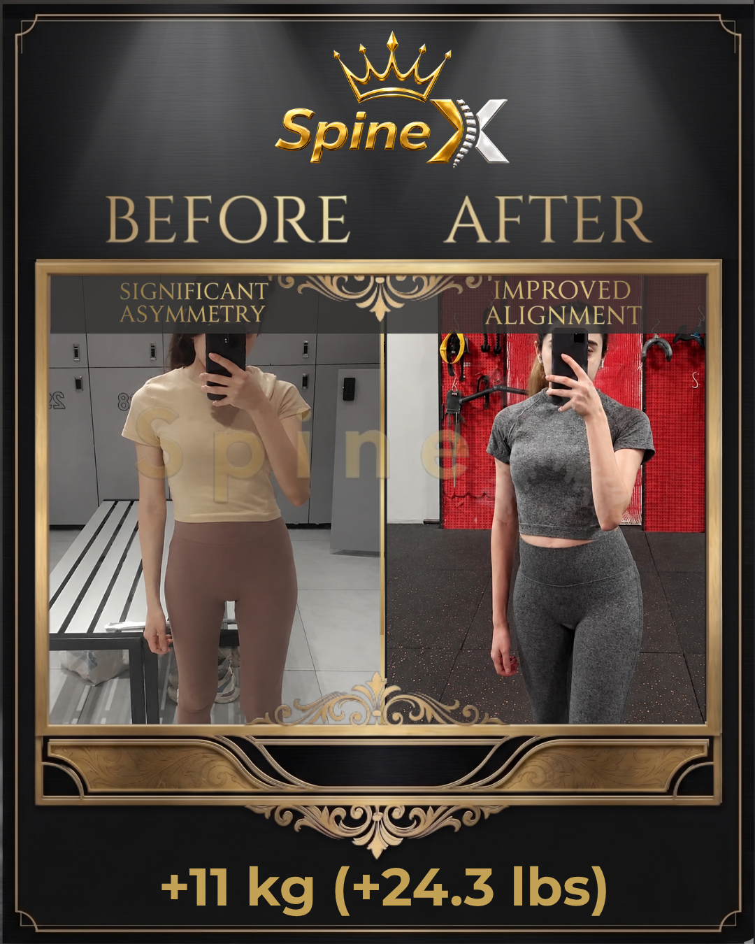 Before-and-after posture comparison supplied for individual SpineX scoliosis coaching, example 33. Individual results vary.
