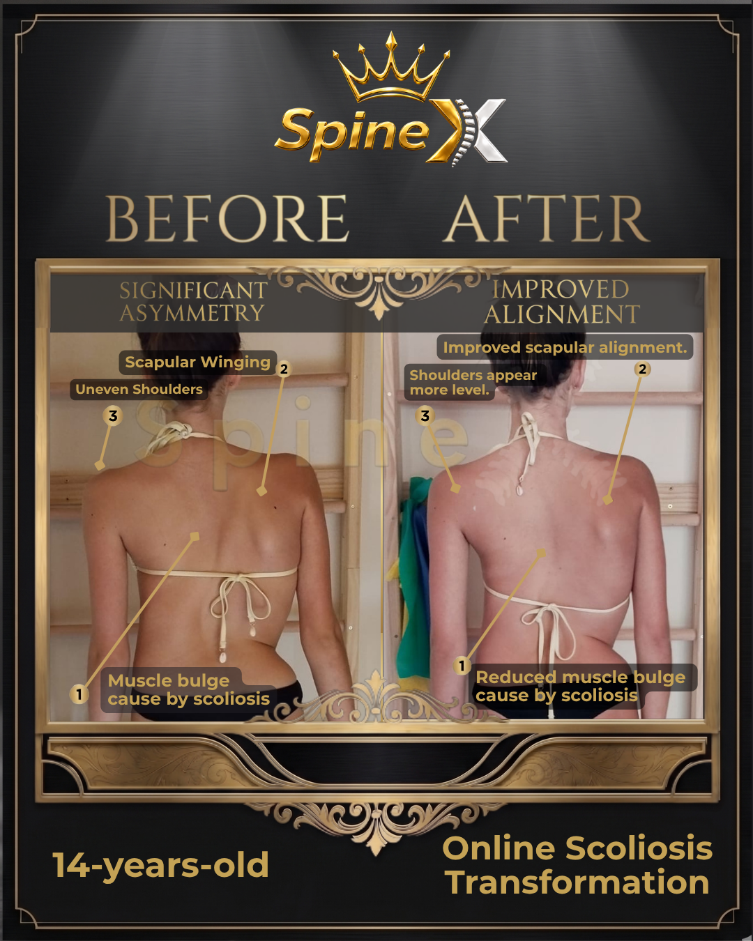 Before-and-after posture comparison supplied for individual SpineX scoliosis coaching, example 35. Individual results vary.