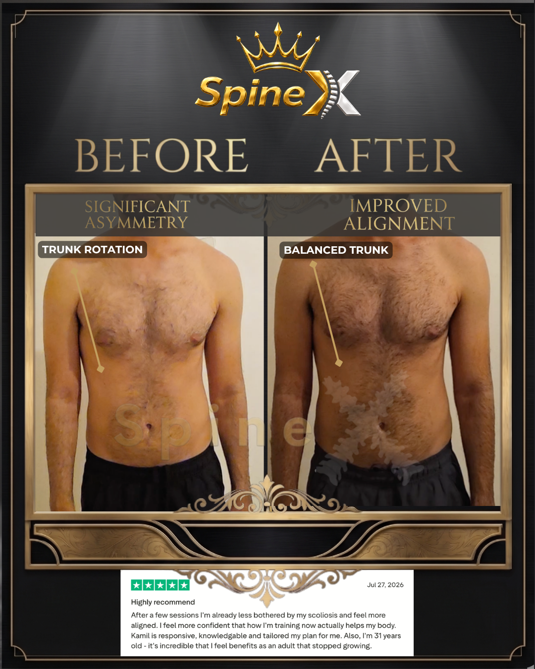 Before-and-after posture comparison supplied for individual SpineX scoliosis coaching, example 38. Individual results vary.