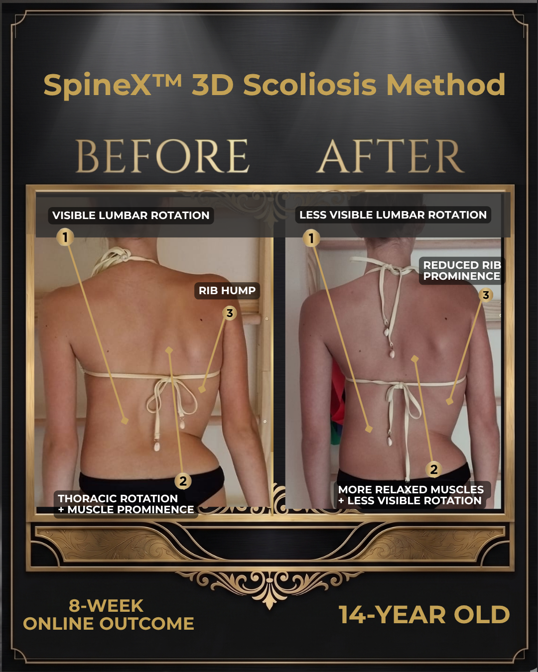 Before-and-after posture comparison supplied for individual SpineX scoliosis coaching, example 39. Individual results vary.