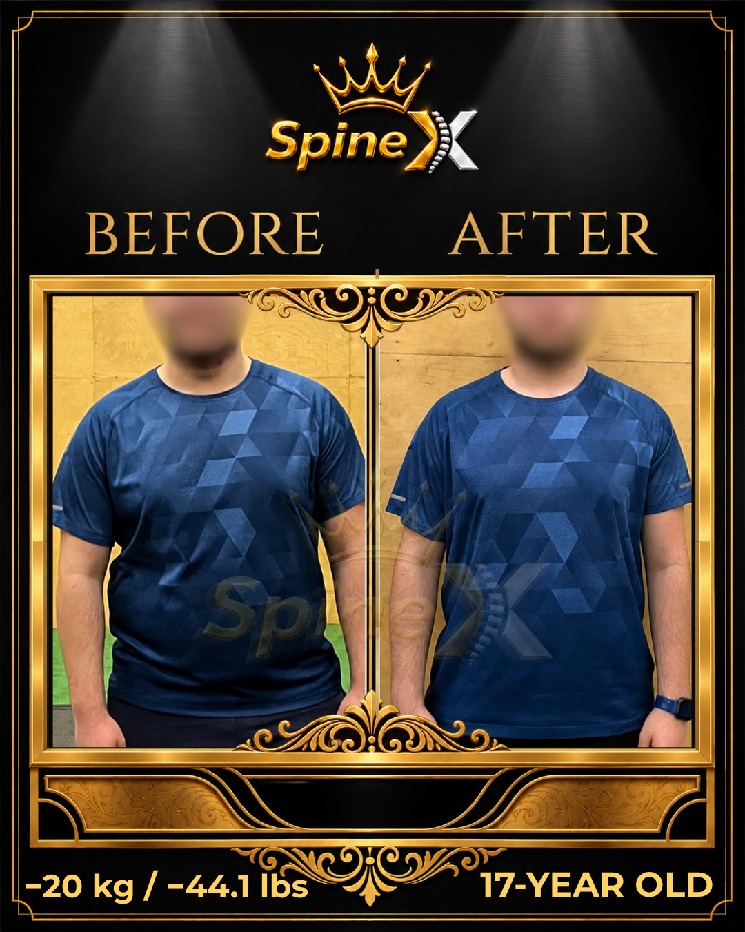 Before-and-after posture comparison supplied for individual SpineX scoliosis coaching, example 42. Individual results vary.